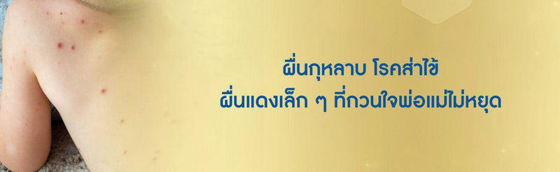 ผื่นกุหลาบ