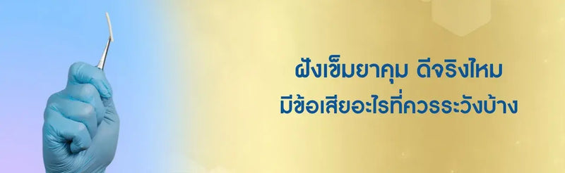 ฝังเข็มยาคุม