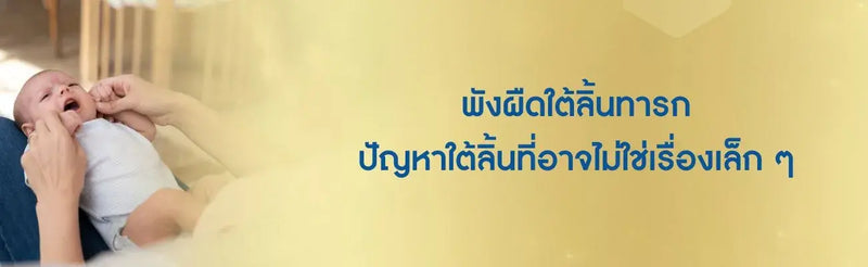 พังผืดใต้ลิ้นทารก