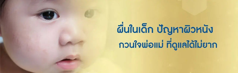 ผื่นในเด็ก