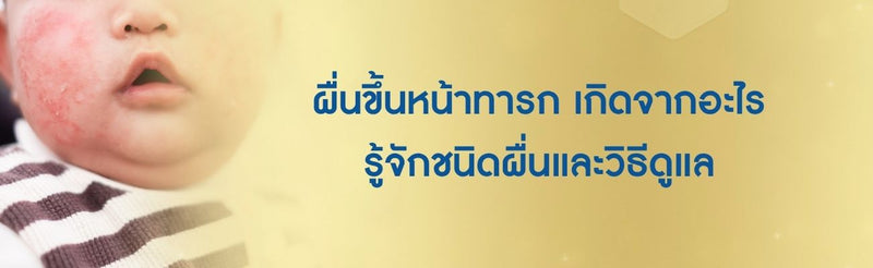 ผื่นขึ้นหน้าทารก